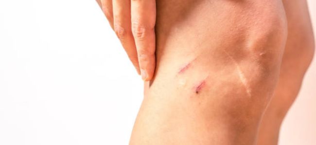 image 10+ Cara Menghilangkan Bekas Luka di Kaki yang Aman & Efektif