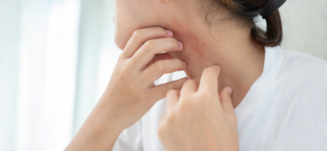 image 10 Cara Menghilangkan Jamur di Kulit dengan Ampuh dan Aman