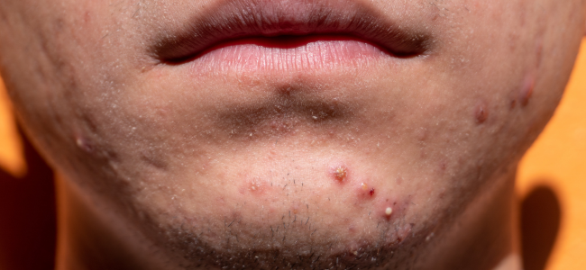 image 10 Cara Menghilangkan Jerawat Nanah Tanpa Dipencet