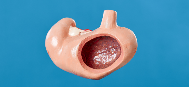 image 10 Ciri Ciri Sakit Ginjal dan Cara Mengobatinya