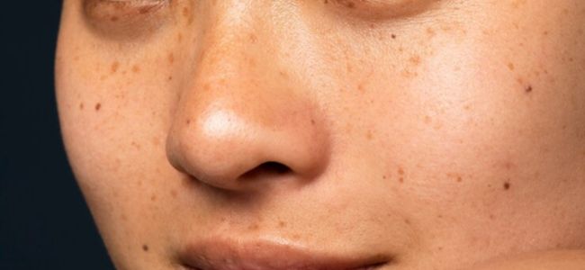 image 10 Rekomendasi Skincare untuk Hiperpigmentasi, Bebas Noda!