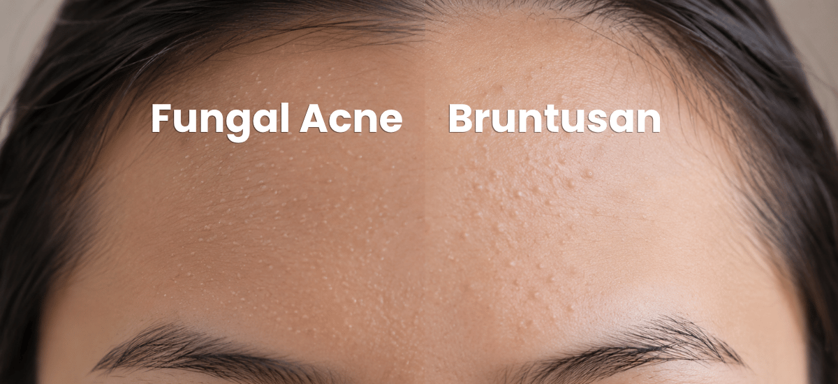 image 6 Perbedaan Fungal Acne dan Bruntusan, Jangan Salah Rawat!