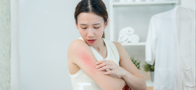 image 8 Cara Menghilangkan Ruam Kulit, Kenali Penyebab dan Jenisnya!