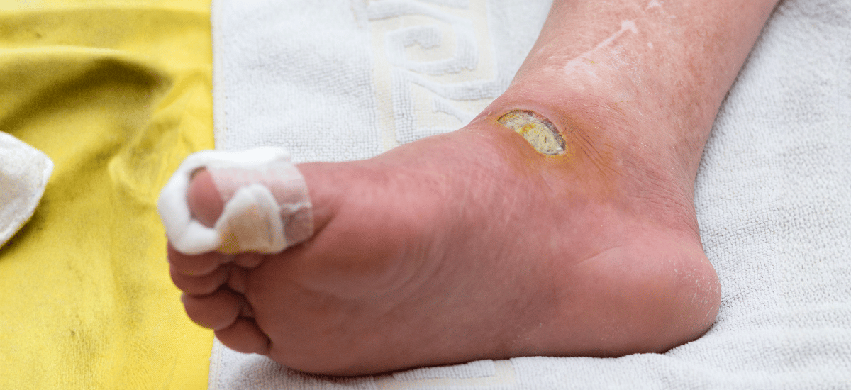 image Diabetes Basah: Penyebab, Gejala, dan Cara Merawat Lukanya