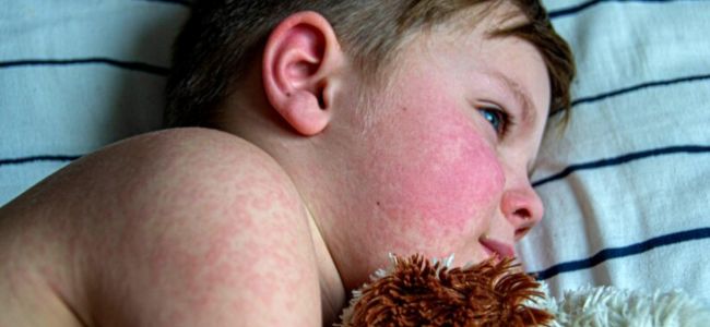 image 3 Fase Gejala Campak Pada Anak yang Wajib Diwaspadai!