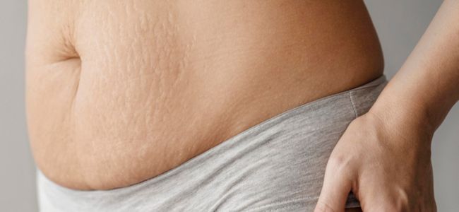 image 4 Cara Mencegah Stretch Mark Saat Hamil, Mudah dan Efektif!