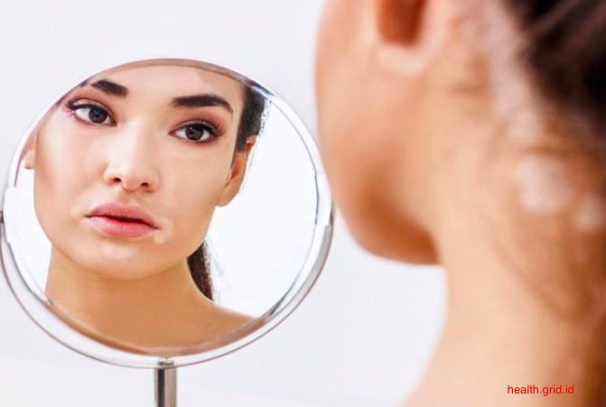 image 4 Cara Menghilangkan Panu di wajah Menggunakan Bahan Alami