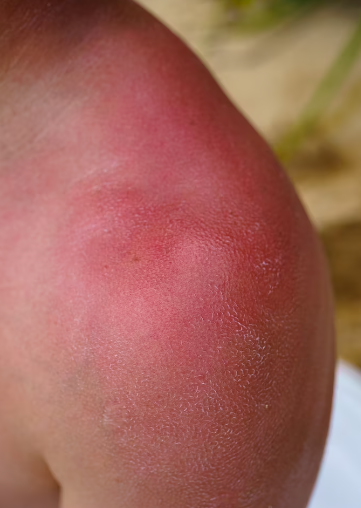 image 4 Obat Biduran Alami yang Paling Ampuh dan Mudah Ditemukan