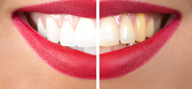 image 5 Cara Memutihkan Gigi Kuning dengan Alami dan Penyebabnya!