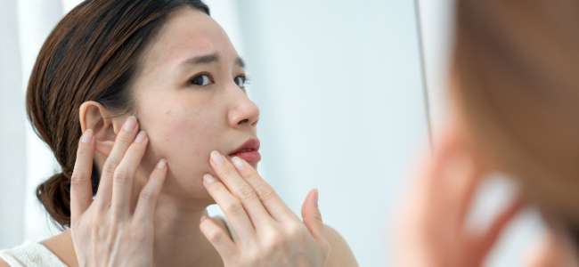 image 5 Cara Mengatasi Kulit Belang yang Ampuh dan Cepat