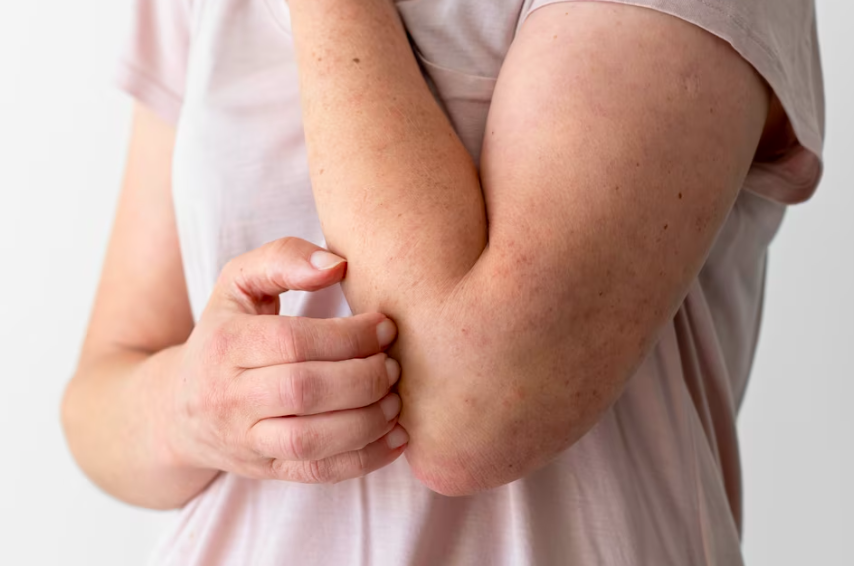 image 5 Cara Menghilangkan Gatal secara Alami dan Cepat