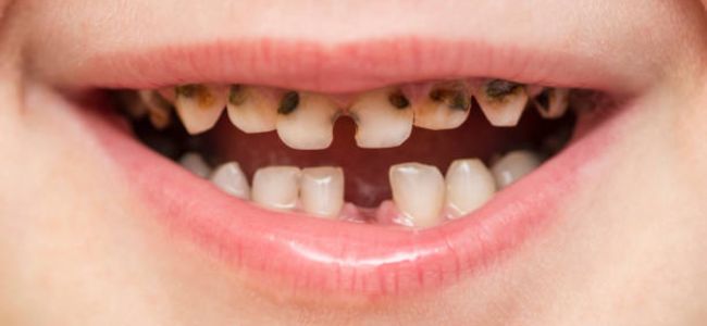 image 5 Cara Merawat Gigi Anak yang Terlanjur Gigis dan Rusak