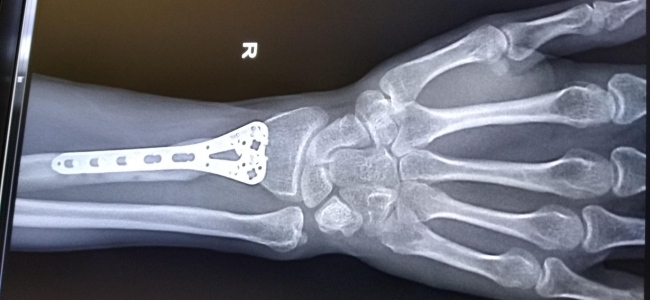 image 5 Jenis Penyakit Tulang Ini Rentan untuk Anak sampai Lansia