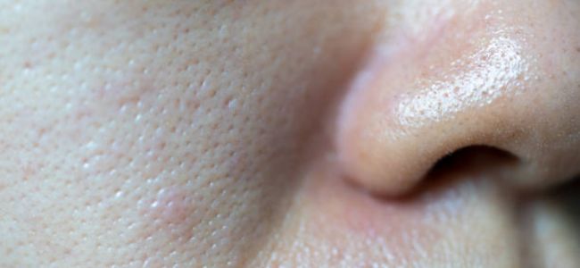 image 6 Cara Mengatasi Pori Pori Besar, Gampang dan Ampuh!