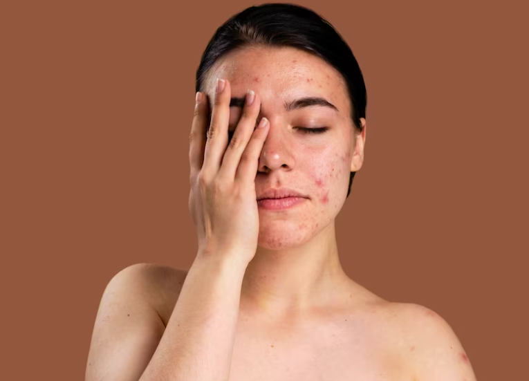 image 6 Cara Menghilangkan Jerawat secara Alami dan Aman