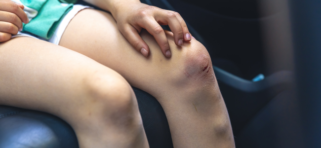 image 6 Cara Mengobati Luka di Lutut Akibat Jatuh dari Motor!