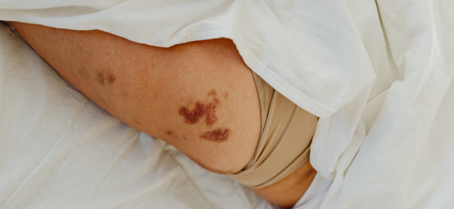 image 6 Cara Mengobati Luka Memar dengan Cepat dan Tidak Sakit