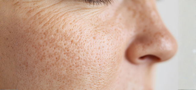 image 7 Cara Mengatasi Pori-Pori Besar di Wajah, Gampang dan Ampuh!