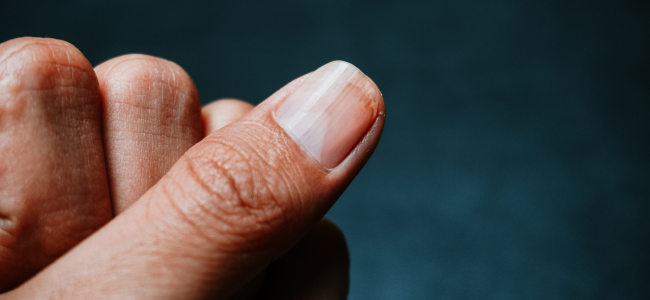 image 7 Contoh Kuku yang Tidak Sehat, Jangan Disepelekan!