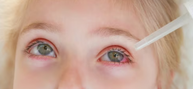 image 7 Penyebab Mata Merah pada Anak dan Cara Mengatasinya