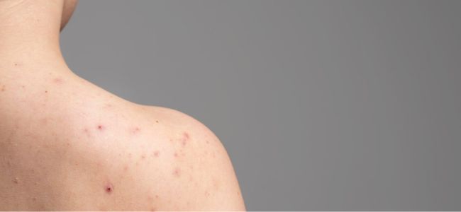 image 7 Rekomendasi Sabun Mandi untuk Jerawat Punggung Terbaik!