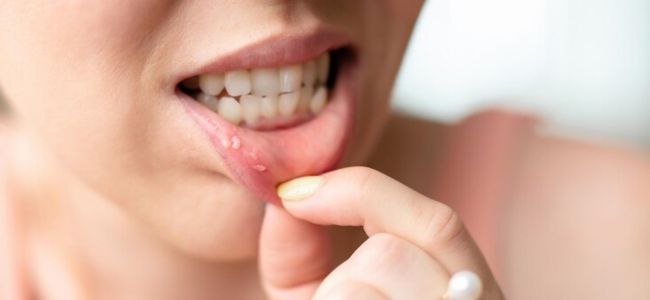 image 8 Rekomendasi Suplemen Vitamin Untuk Sariawan Terbaik