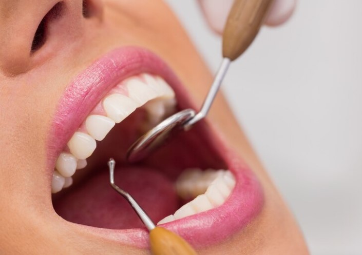 image 9 Cara Menghilangkan Karang Gigi Secara Alami, Wajib Coba!