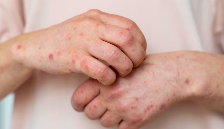 image Apa Itu Herpes? Pahami Gejala hingga Cara Pencegahannya