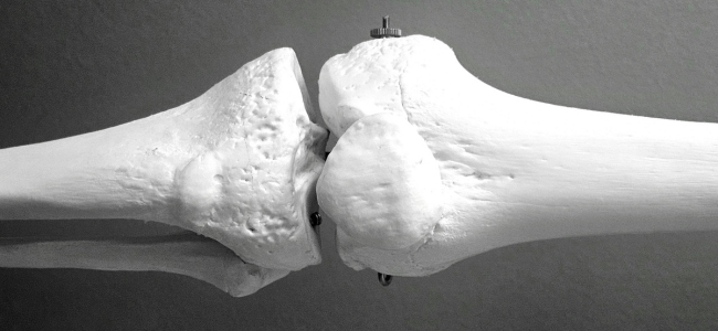 image Apa Itu Osteoporosis? Ketahui Jenis, Gejala, dan Cara Obatinya!