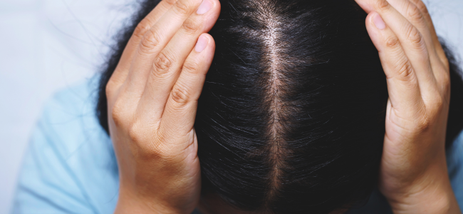 image Apakah Stres Bisa Membuat Rambut Rontok? Ini Faktanya!