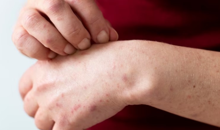 image Kulit Gatal? Kenali Berbagai Jenis Jamur Kulit Ini Segera!