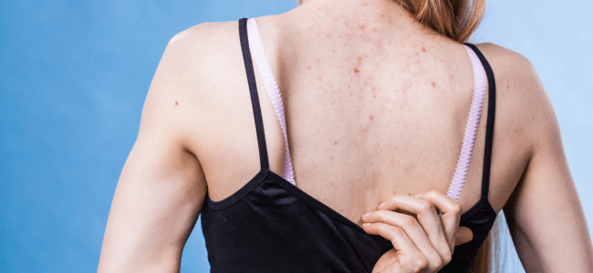 image Begini Cara Menghilangkan Jerawat Punggung Paling Ampuh & Efektif