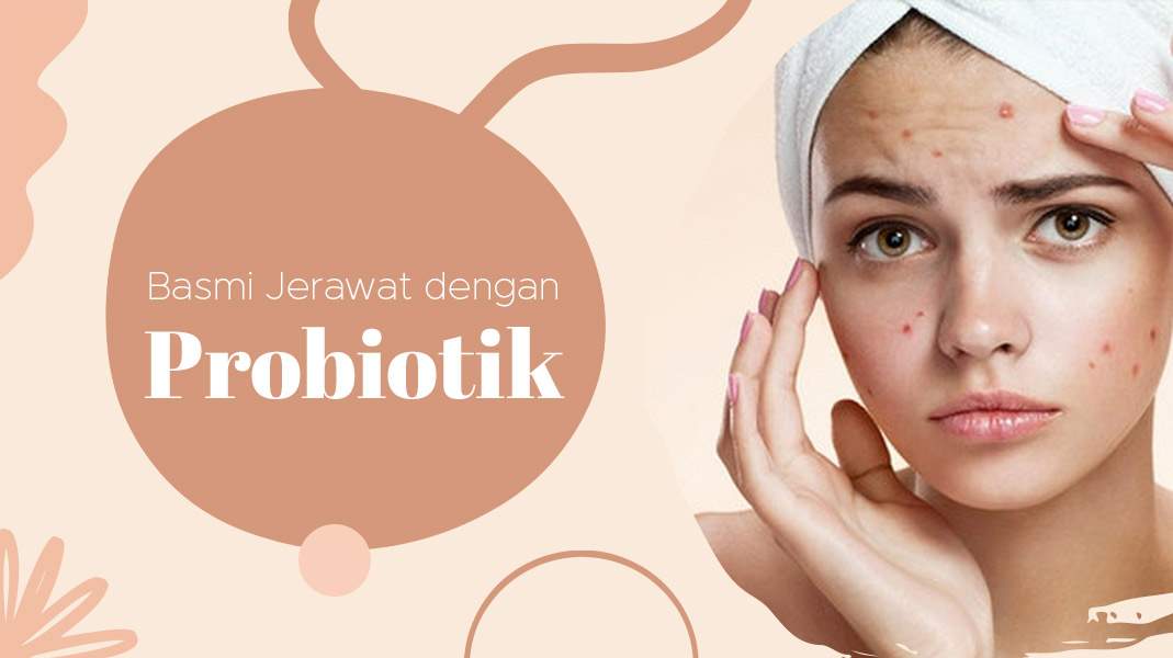 image Probiotik untuk Jerawat: Solusi Kulit Sehat dan Bebas Breakout!