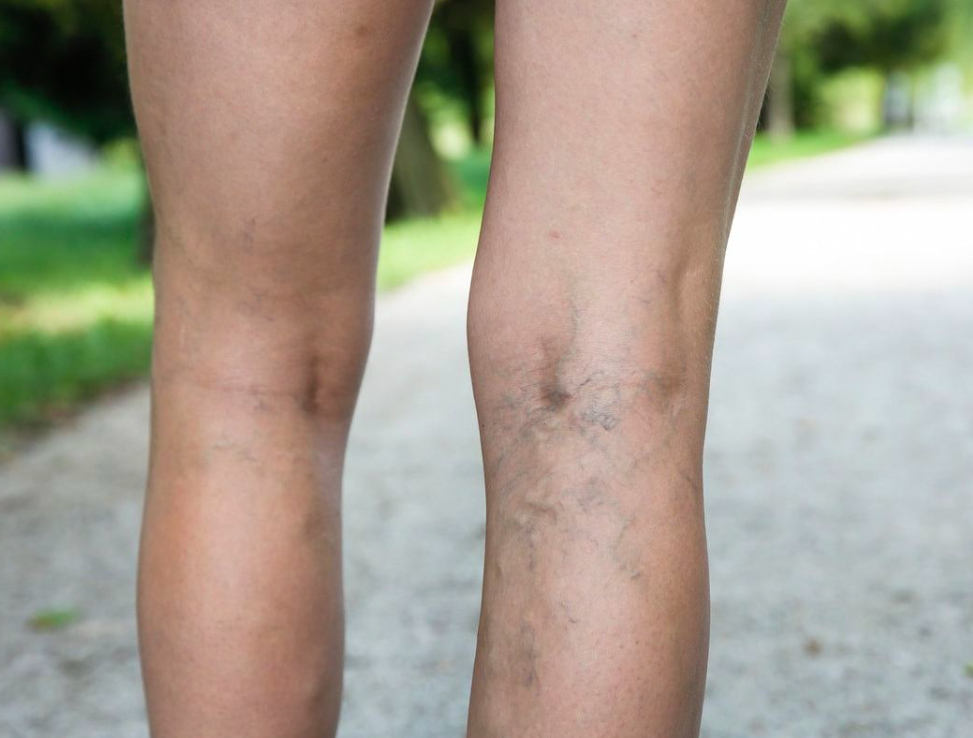 image Berbagai Cara Menghilangkan Varises Yang Dilakukan Secara Medis