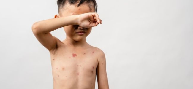 image Cacar Air Pada Anak: Gejala, Cara Mencegah dan Mengatasinya!
