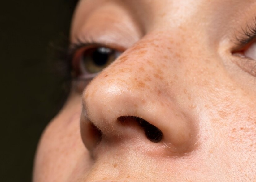 image Cara Cepat Menghilangkan Flek Hitam di Wajah Yang Membandel