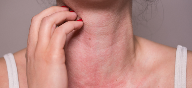 image Cara Mengatasi Alergi Makanan: Kenali Gejala dan Pemicunya