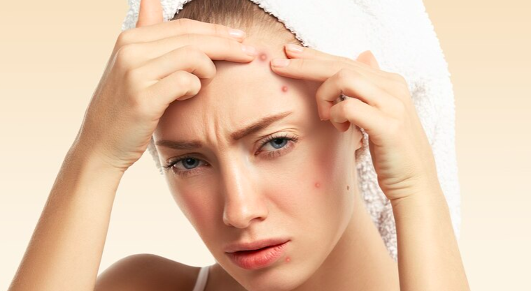 image Cara Menghilangkan Jerawat Dengan Cepat Tanpa Meninggalkan Bekas