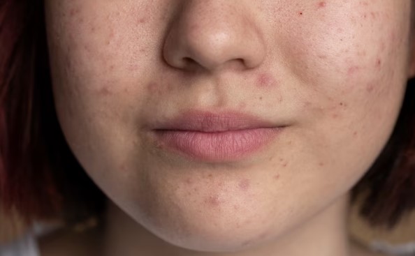 image Cara Menghilangkan Jerawat di Pipi, Bantu Kembalikan Kepercayaan Diri!