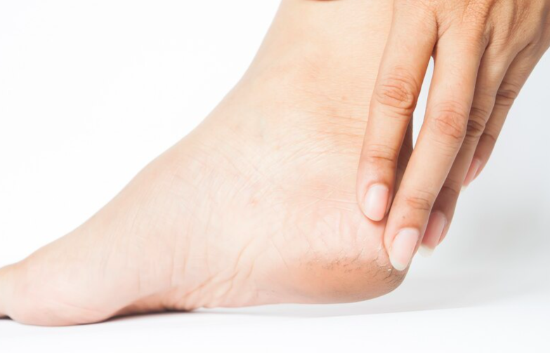 image Penyebab dan Cara Menghilangkan Kaki Pecah-Pecah Permanen