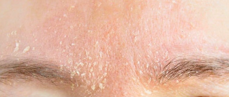 image Cara Menghilangkan Panu Sampai Ke Akarnya Dengan Efektif dan Tepat