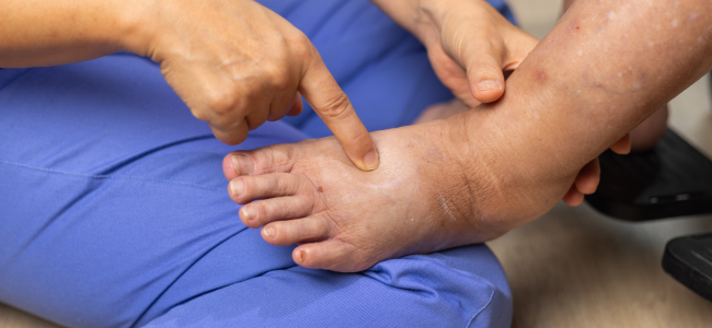 image Diabetes Kering, Kenali Penyebab dan Cara Mengobatinya