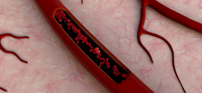 image Ini 6 Cara Melancarkan Pembuluh Darah yang Tersumbat!