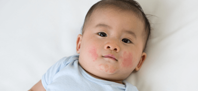 image Ini Penyebab Bruntusan pada Bayi dan Cara Mengatasinya!