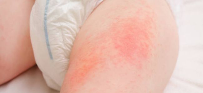 image Kenali Ciri Ciri Ruam Popok Akan Sembuh & Cara Mengatasinya