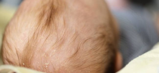image Kulit Kepala Bayi Kering? Cek Penyebab dan Cara Mengatasinya!