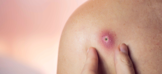 image Makanan Penyebab Bisul yang Harus Dihindari untuk Kulit Sehat