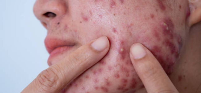 image Mengenal Jenis Jenis Jerawat dan Cara Tepat untuk Mengatasinya