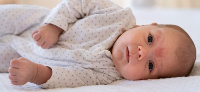 image Pahami 5 Cara Mengatasi Eksim Pada Bayi dan Gejalanya!