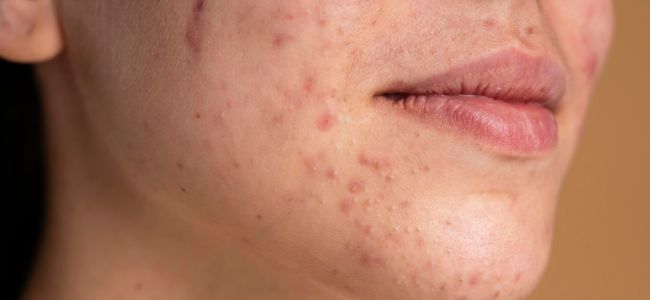 image Pahami 5 Manfaat Sulfur untuk Jerawat, Ternyata Aman!